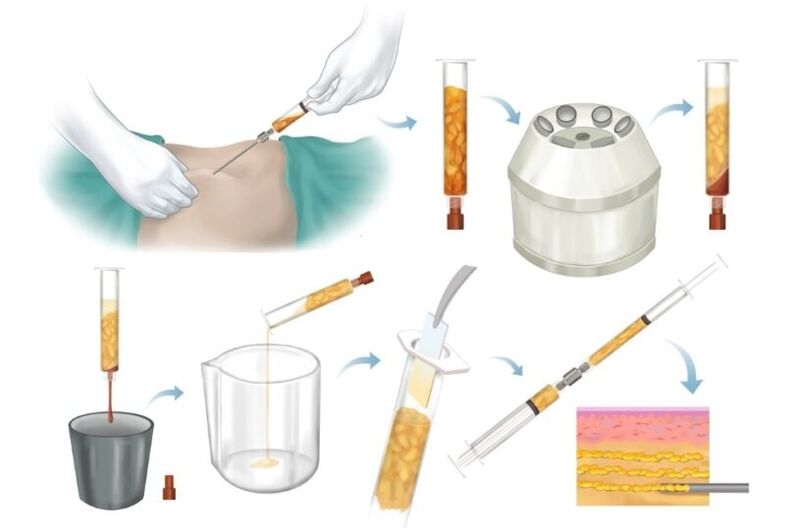 Eliminación de grasa de áreas problemáticas, procesamiento e inyección en tejido mamario.