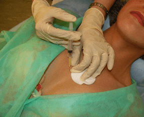 Introducción de meso-cóctel en el tejido mamario una alternativa a las inyecciones de ácido hialurónico