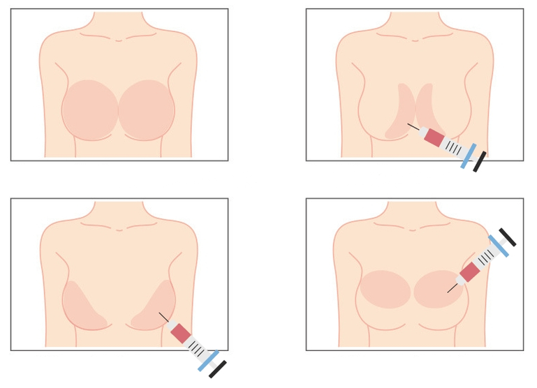 Lugares para la inyección de ácido hialurónico en el pecho.