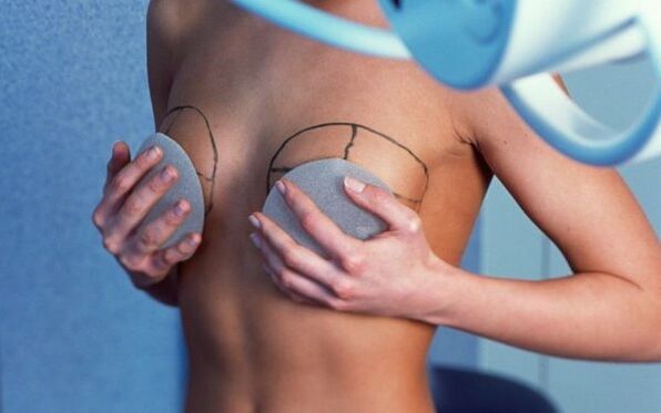 aumento de senos con implantes