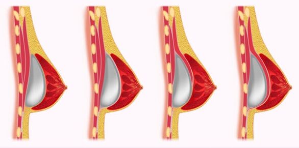 métodos de instalación de implantes para agrandar los senos